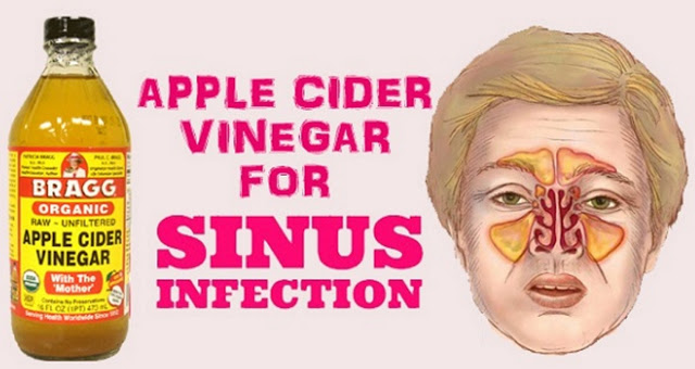 5 Ways to Use Apple Cider Vinegar For Sinus Infection