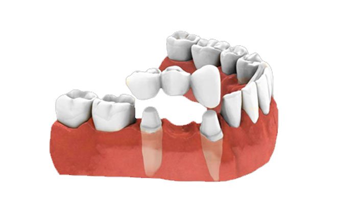 Dental-Bridge