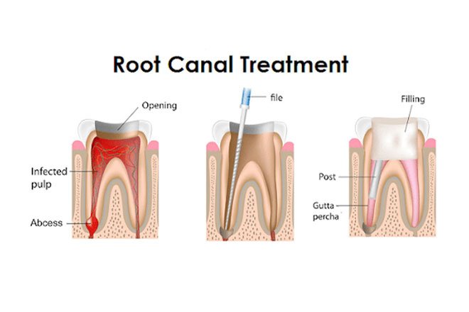 root-canal