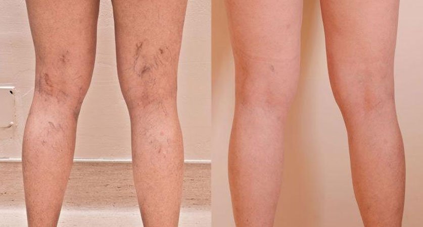 Vein Treatment