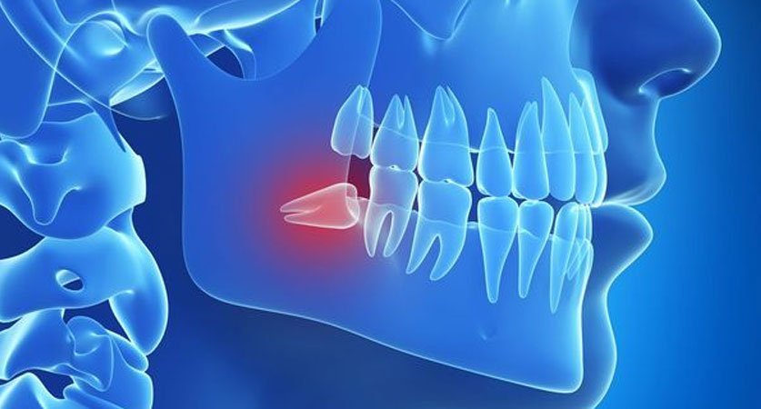 wisdom teeth removal cost