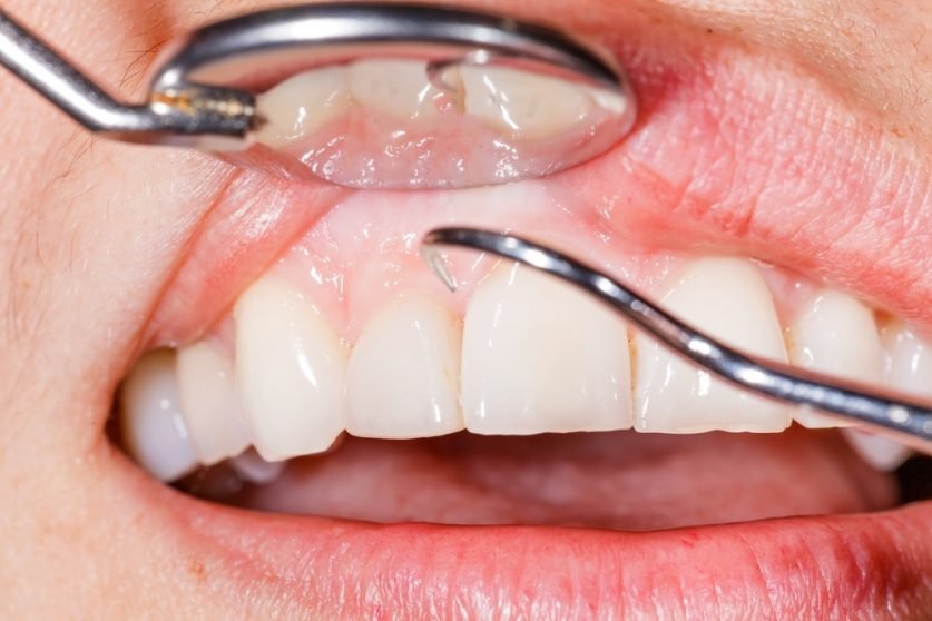 deep cleaning teeth