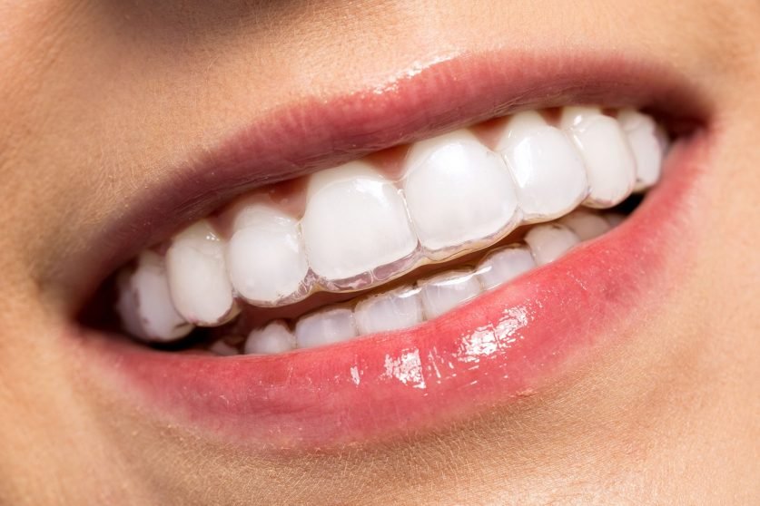 Invisalign Treatment