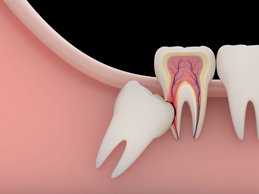 Impacted Wisdom tooth