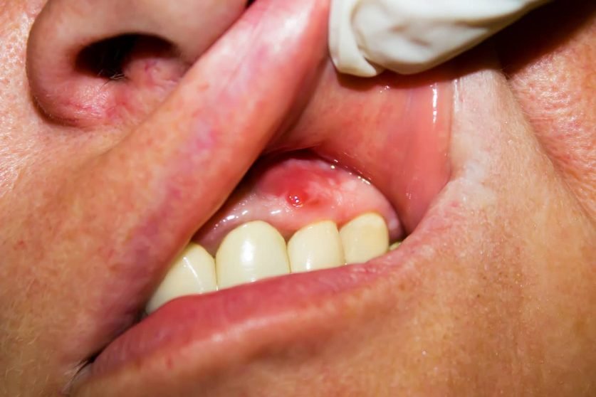 tooth abscess