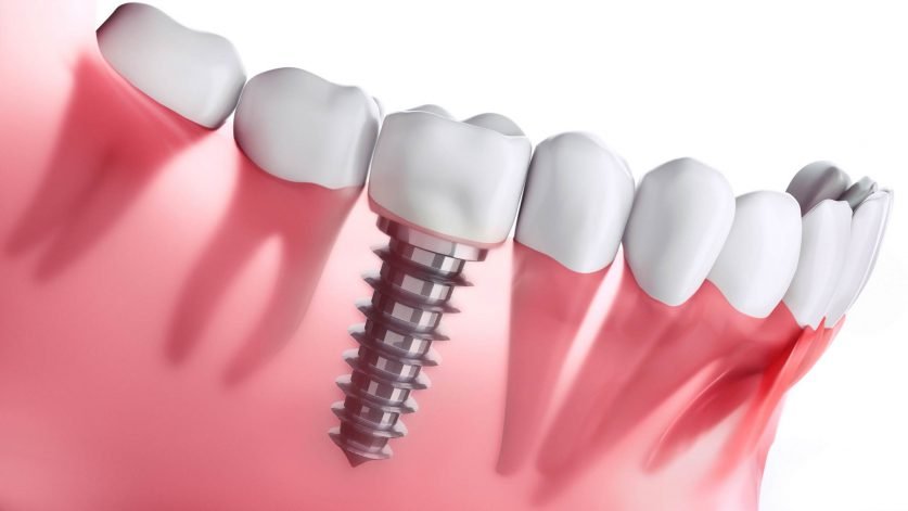 Dental Implants