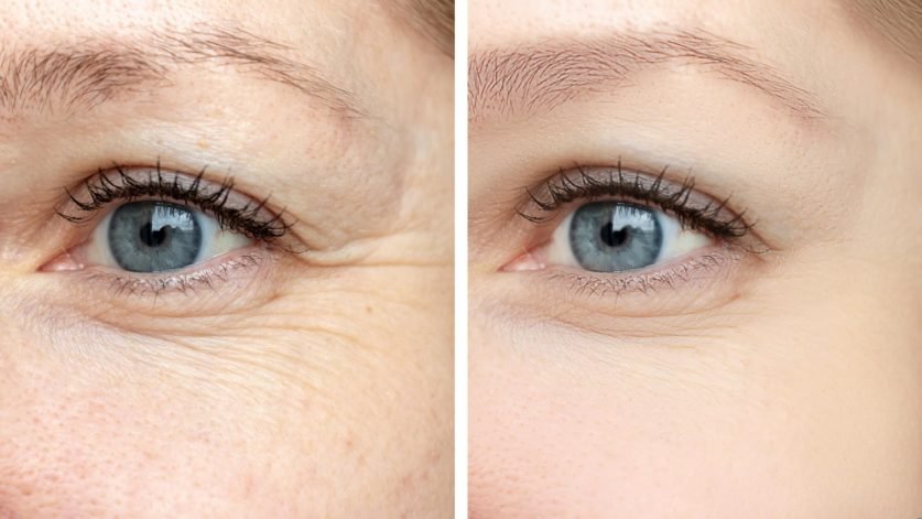 eye lift surgery