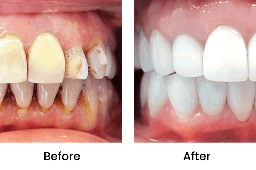 Full Mouth Restoration