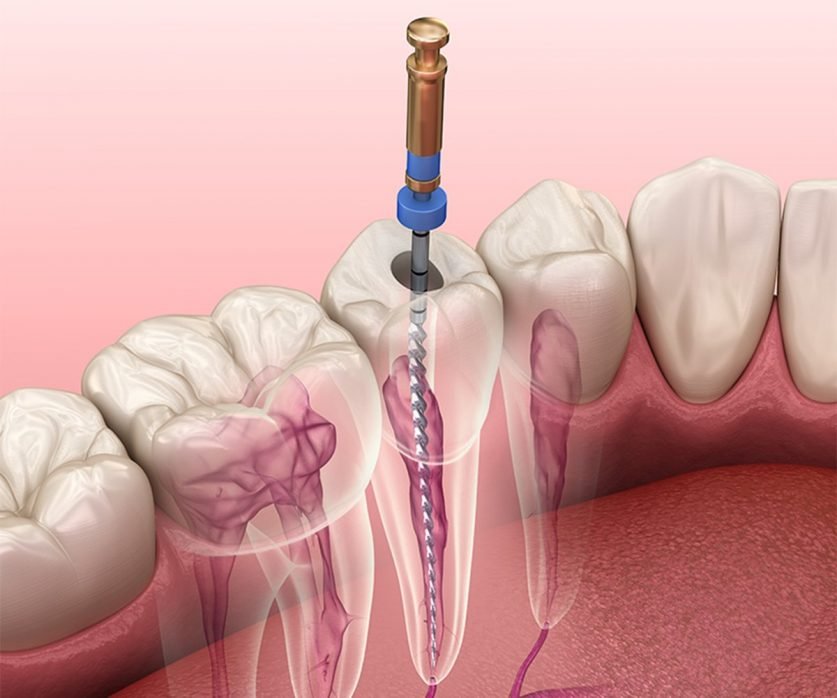 Root Canal