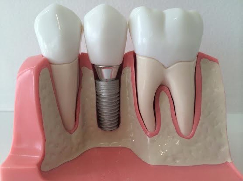 Dental Implants