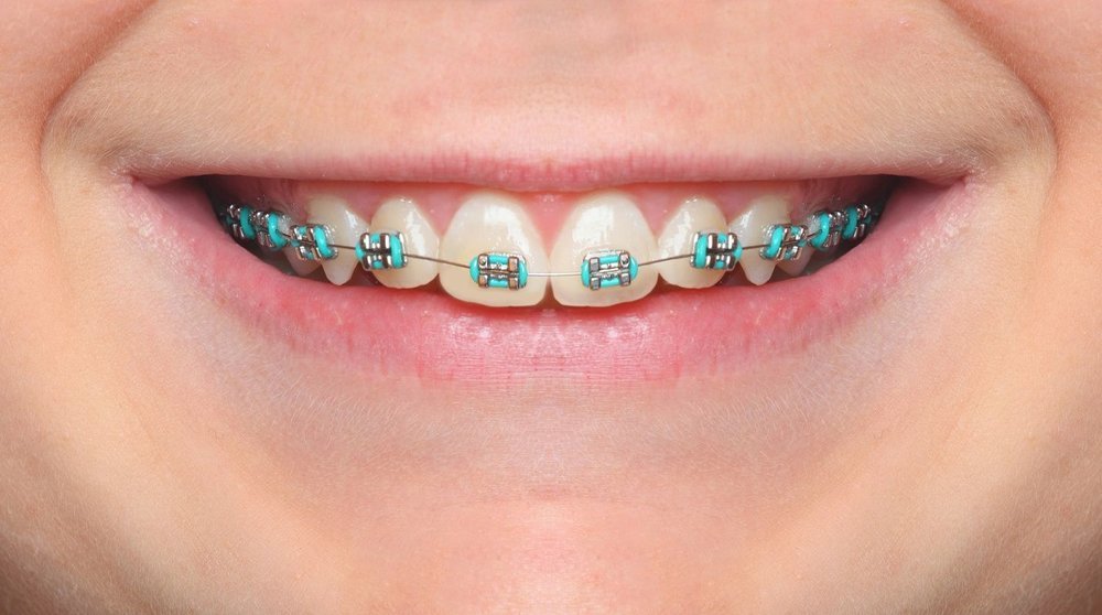 braces colors