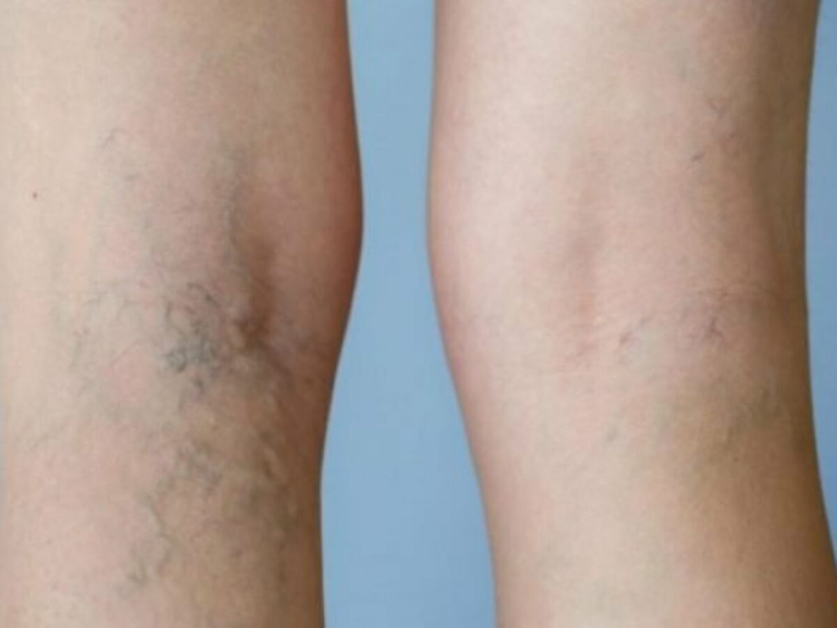 How much does varicose vein treatment cost