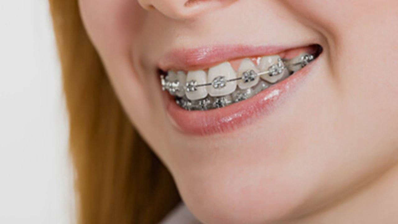 Overbite Braces