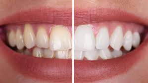 tooth crown before and after