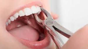 emergency tooth extraction near me in Houston Heights