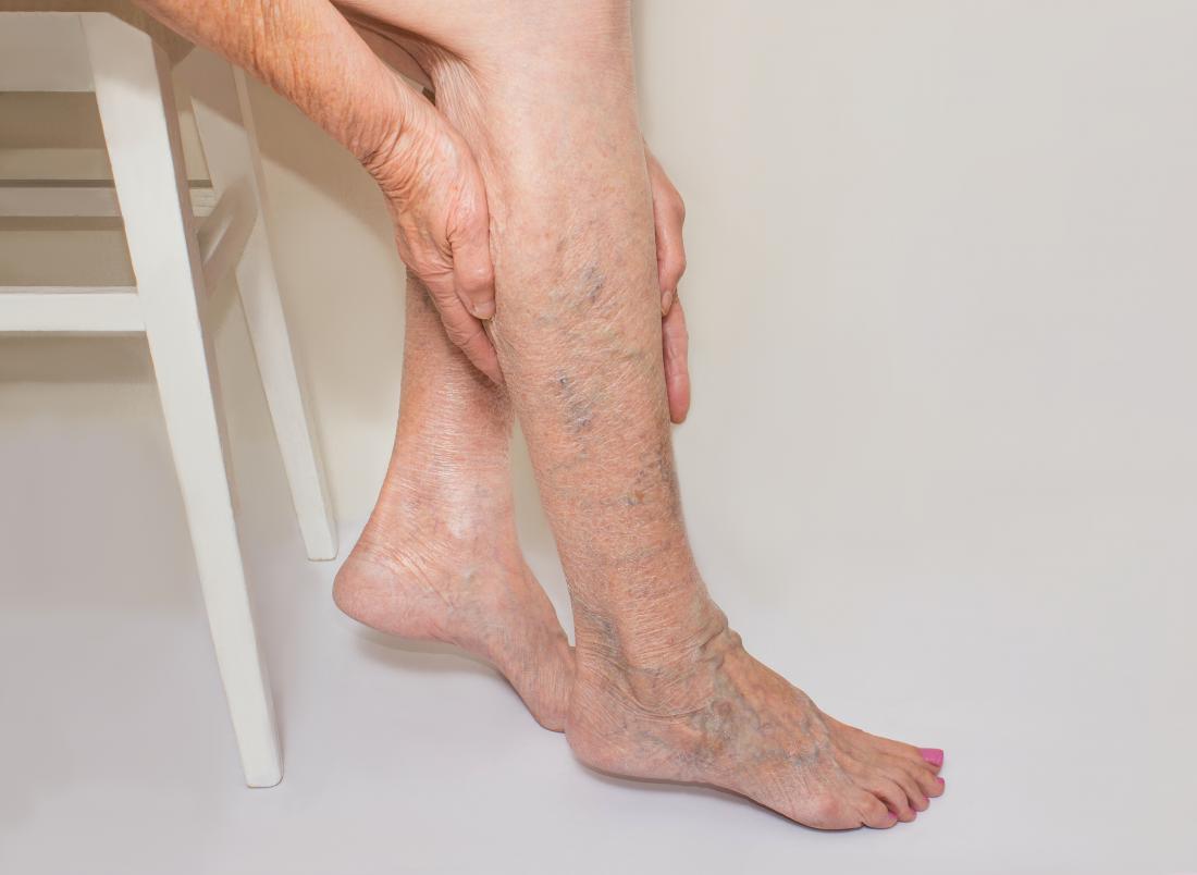 What Kind of Doctor Treats Varicose Veins