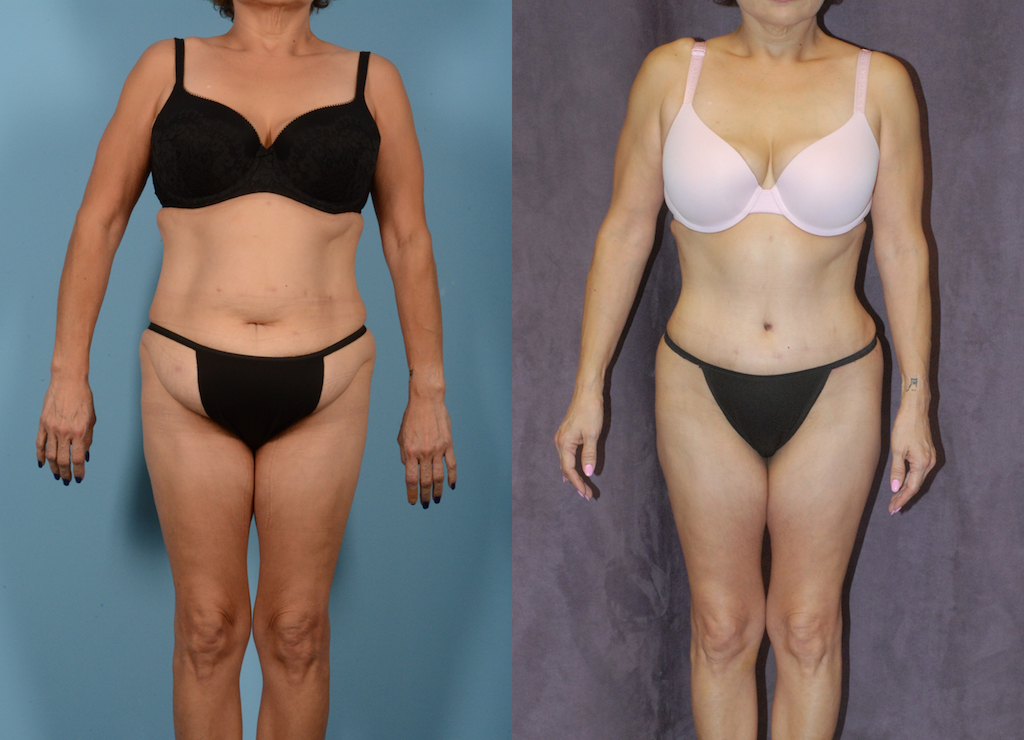 Liposuction Before And After