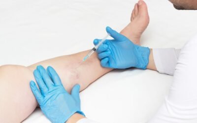 do spider veins come back after laser treatment