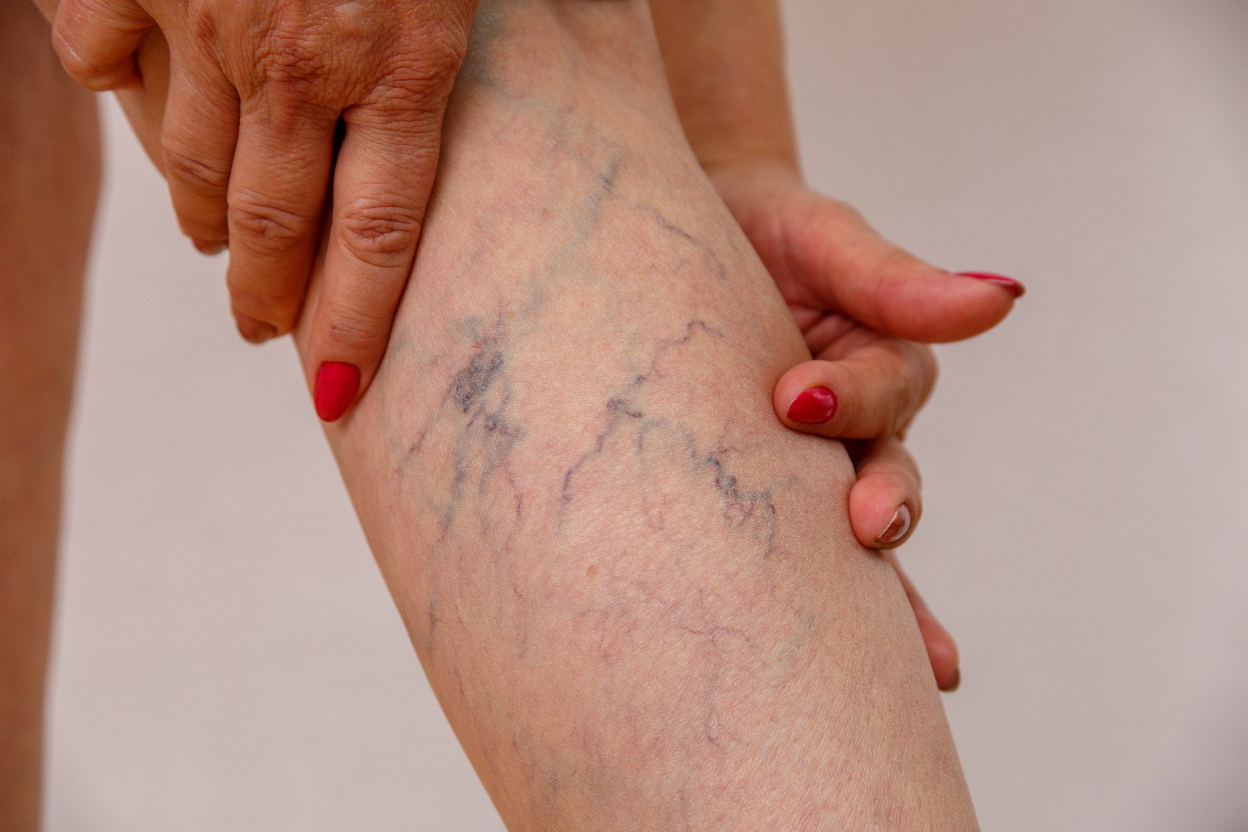 How can I get rid of varicose veins without surgery