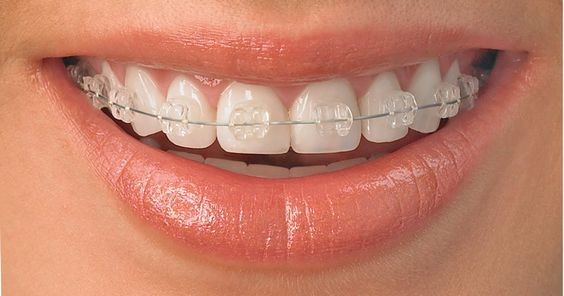 orthodontics braces