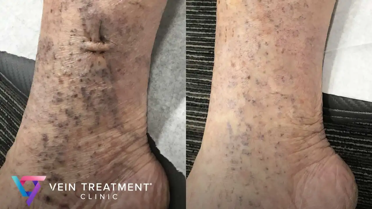 Chronic venous insufficiency specialists
