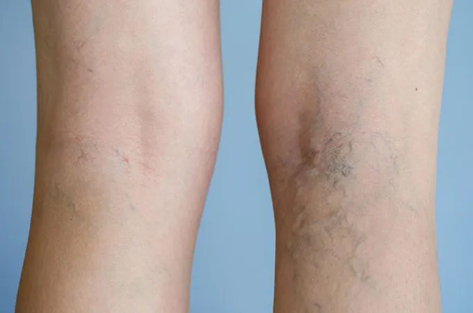 varicose vein doctor NYC