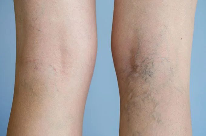 varicose vein treatment New York