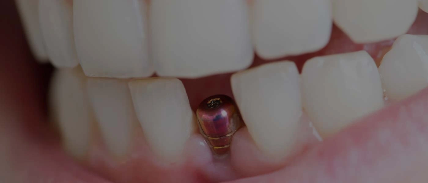 Teeth Replacement Houston