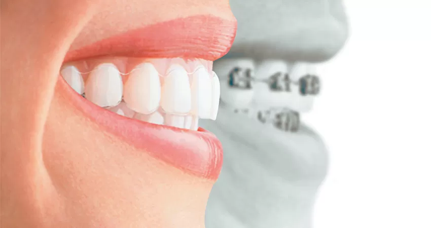 invisalign cost
