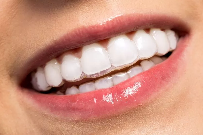 Invisalign Treatment