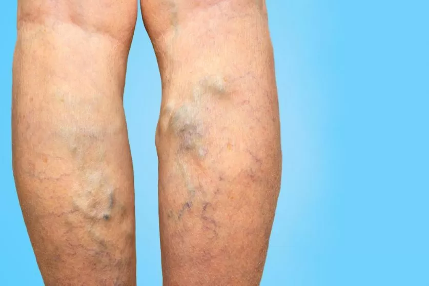 Vein Disease