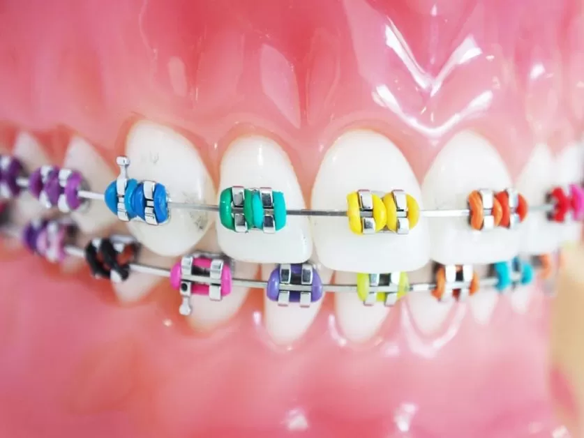 Best Suitable Braces