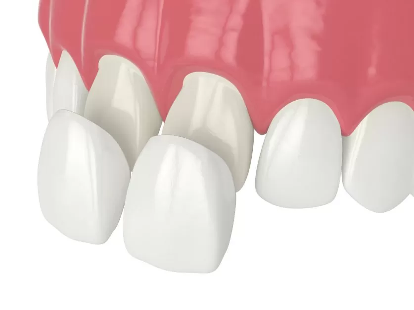 Veneers