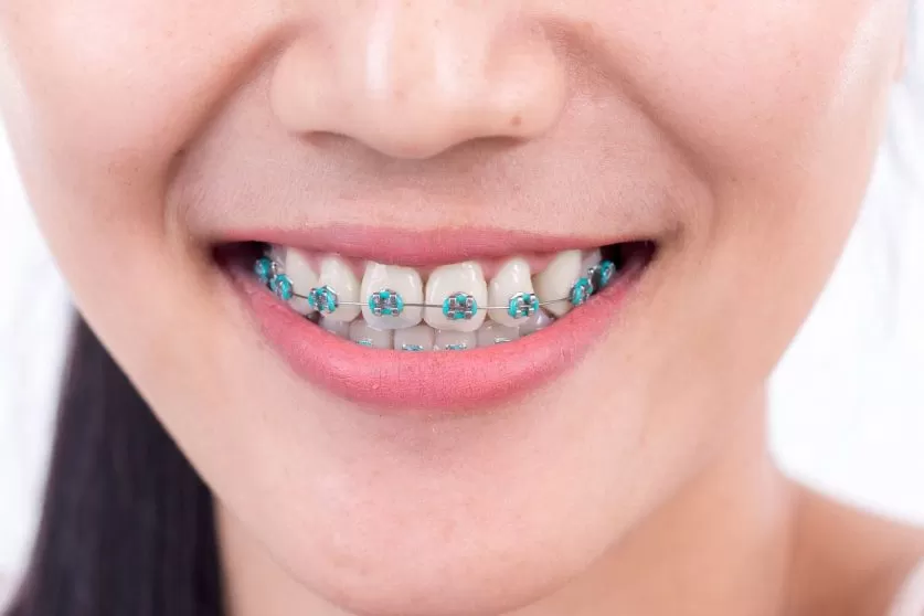 power chains braces