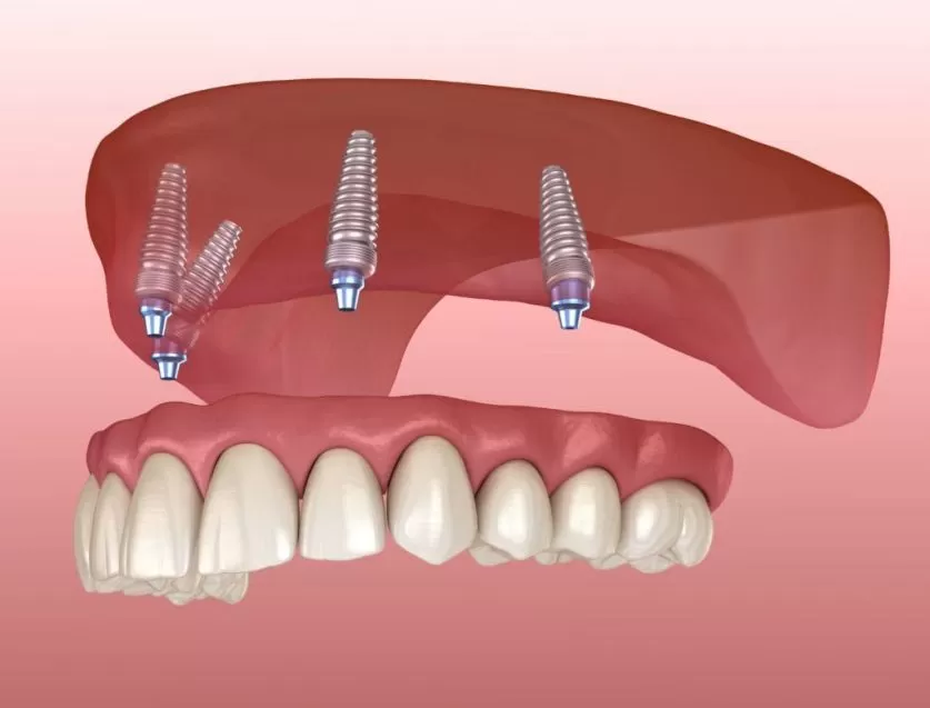 Dental Implant Dentures
