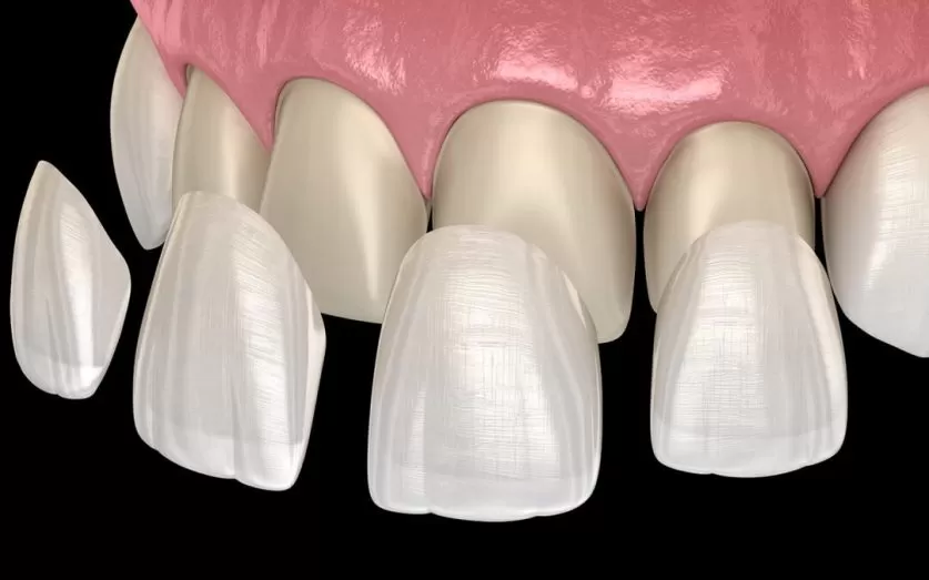 dental veneers