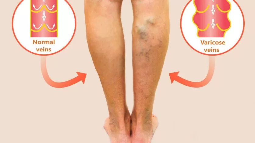 varicose vein treatment