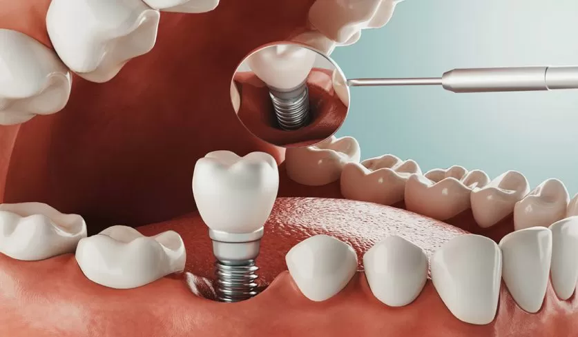 Dental Implant