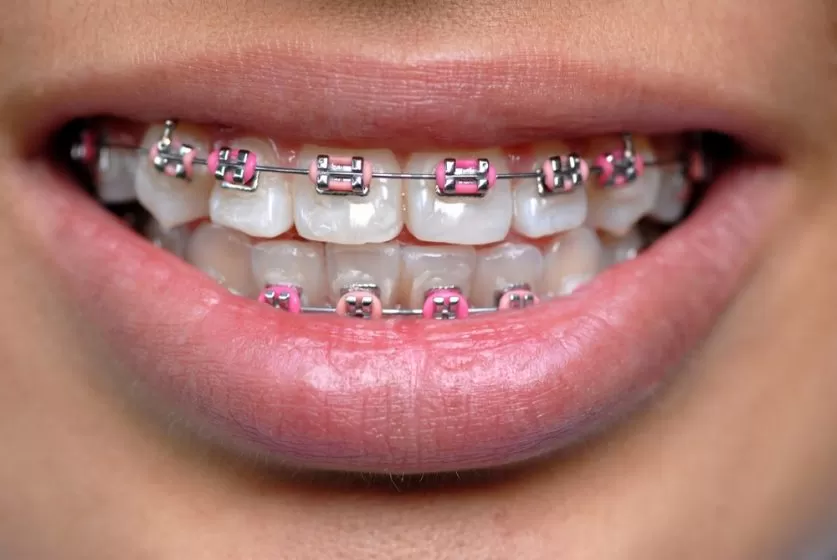 braces colors