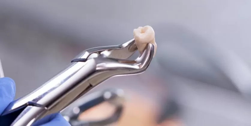 Tooth Extraction Procedure