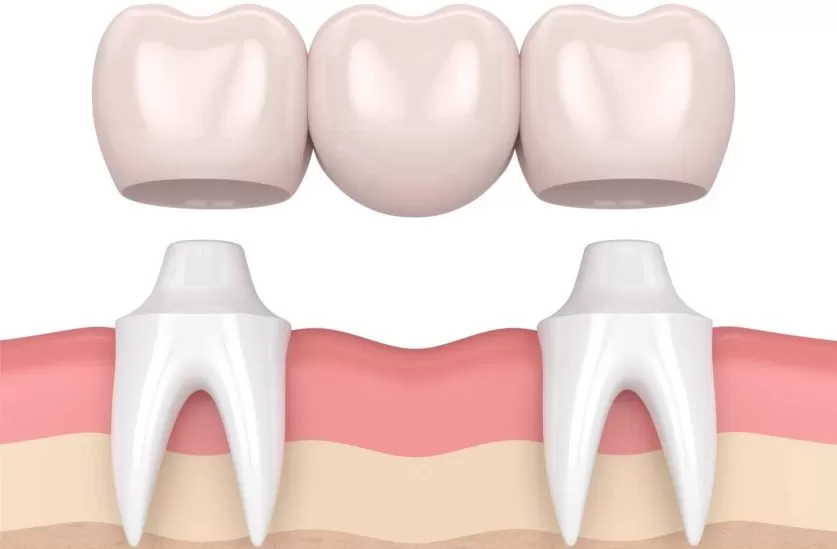 Dental Bridges