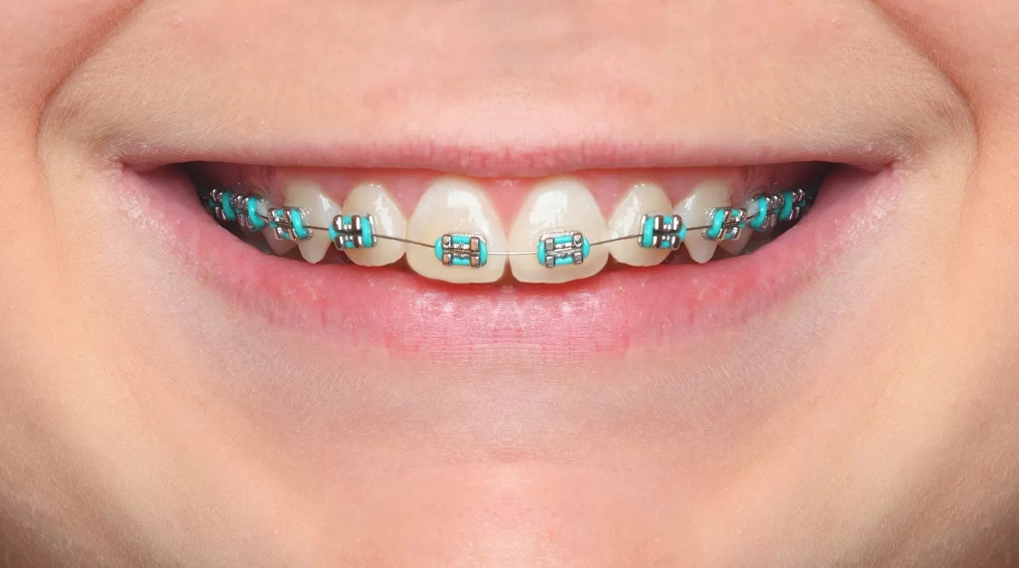 braces color