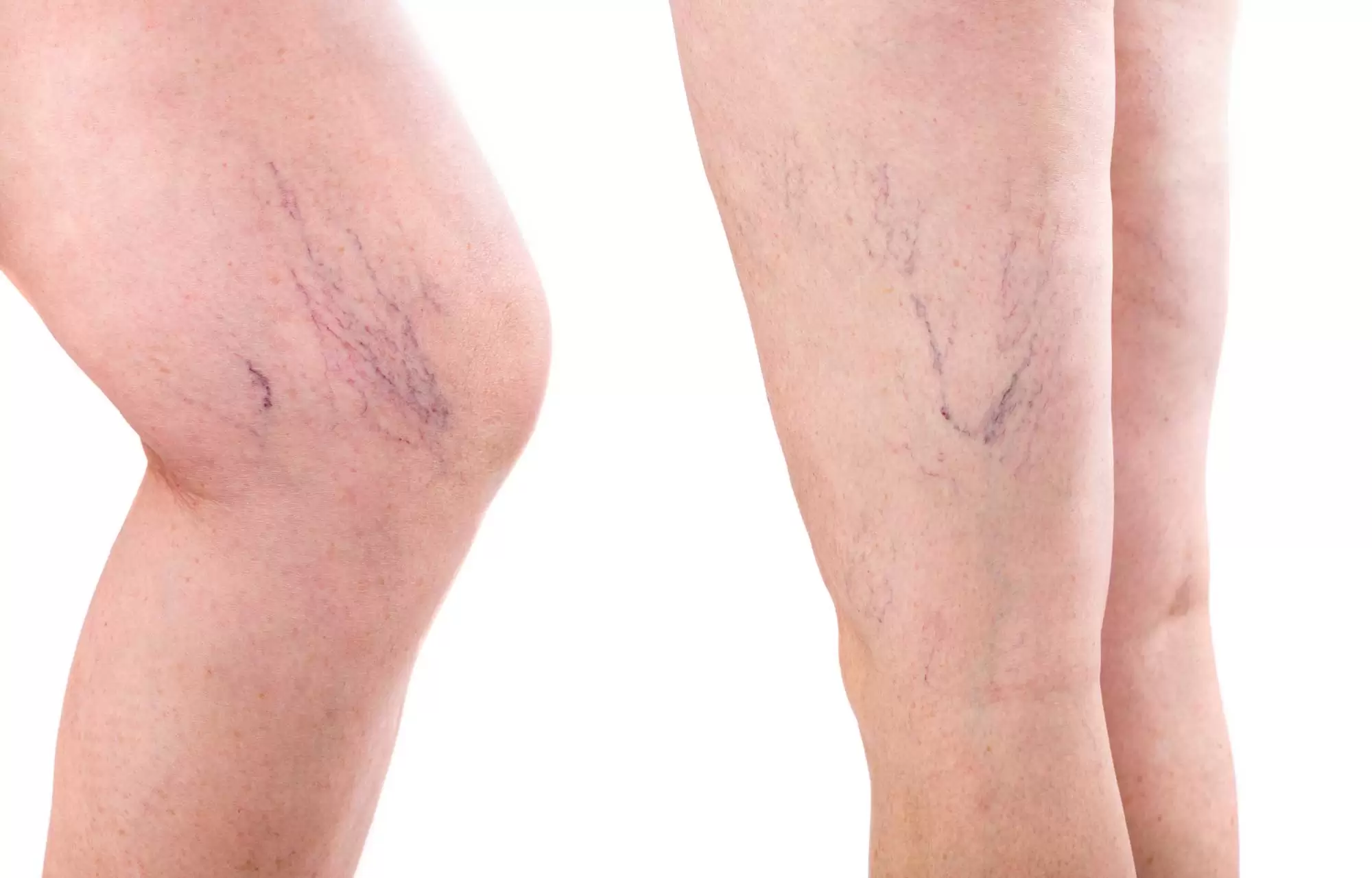 How much does it cost to get your veins stripped