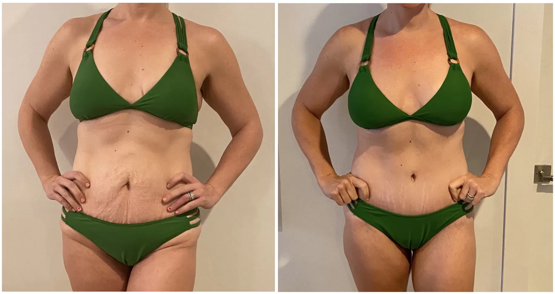 mommy makeover before and after