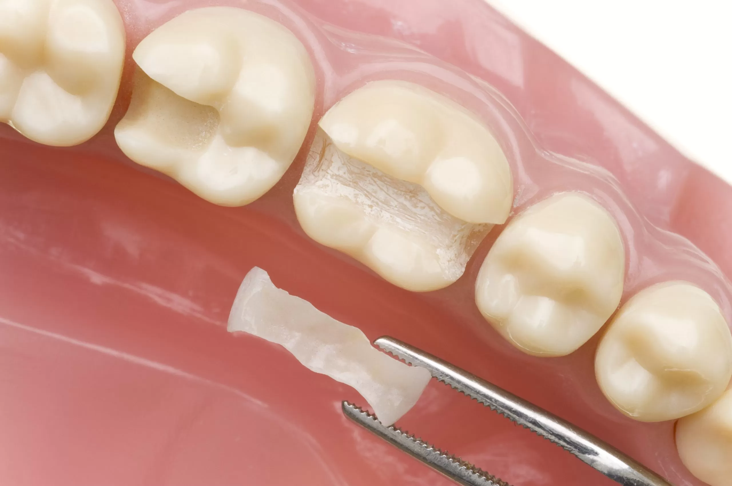 Tooth Colored Fillings